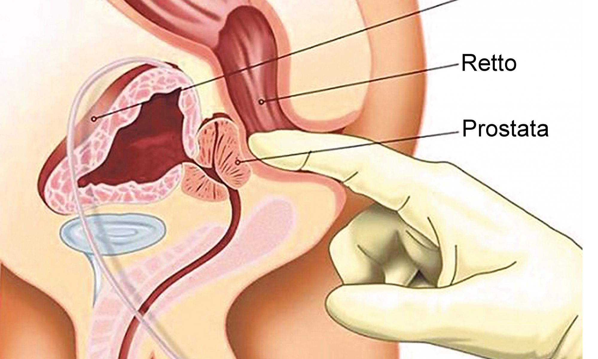 come trovare la prostata